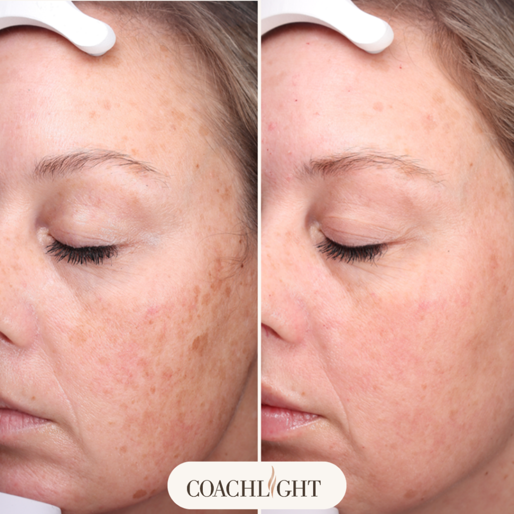 Halo Laser Treatment 1 Halo