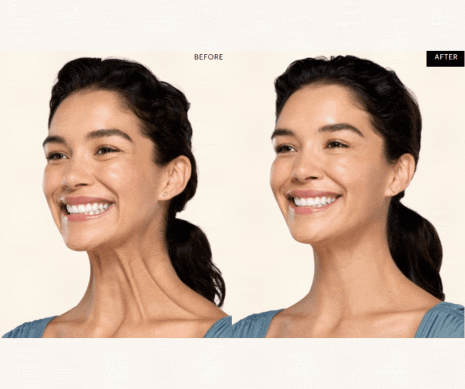 Platysma Bands Contact Gif Template Horizontal