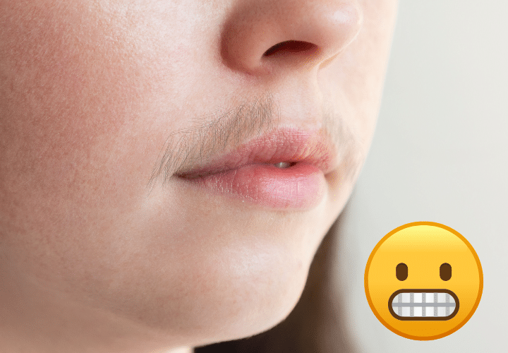 Laser Hair Removal